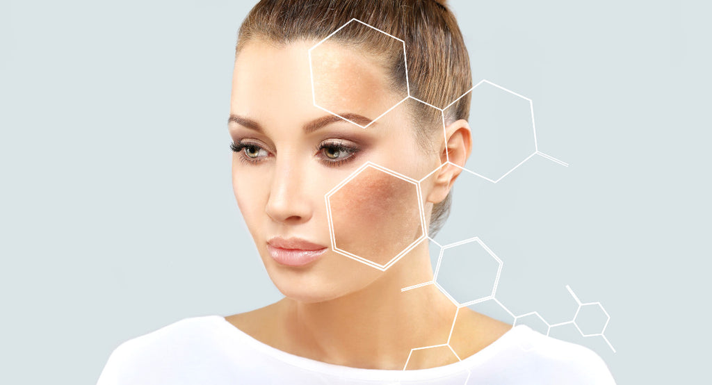 attractive woman with hyperpigmentation highlighted on cheek and forehead