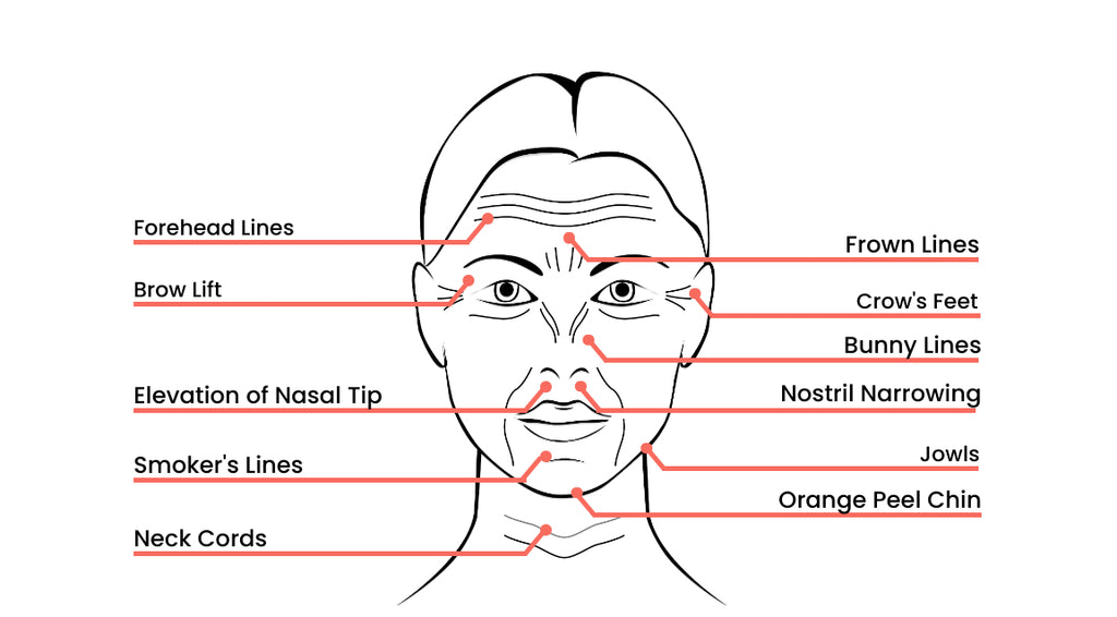 womans face and neck diagram with highlighted conditions commonly treated by botox